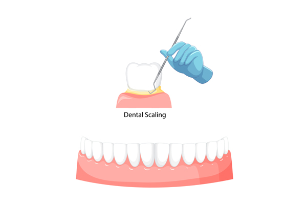 Teeth Scaling